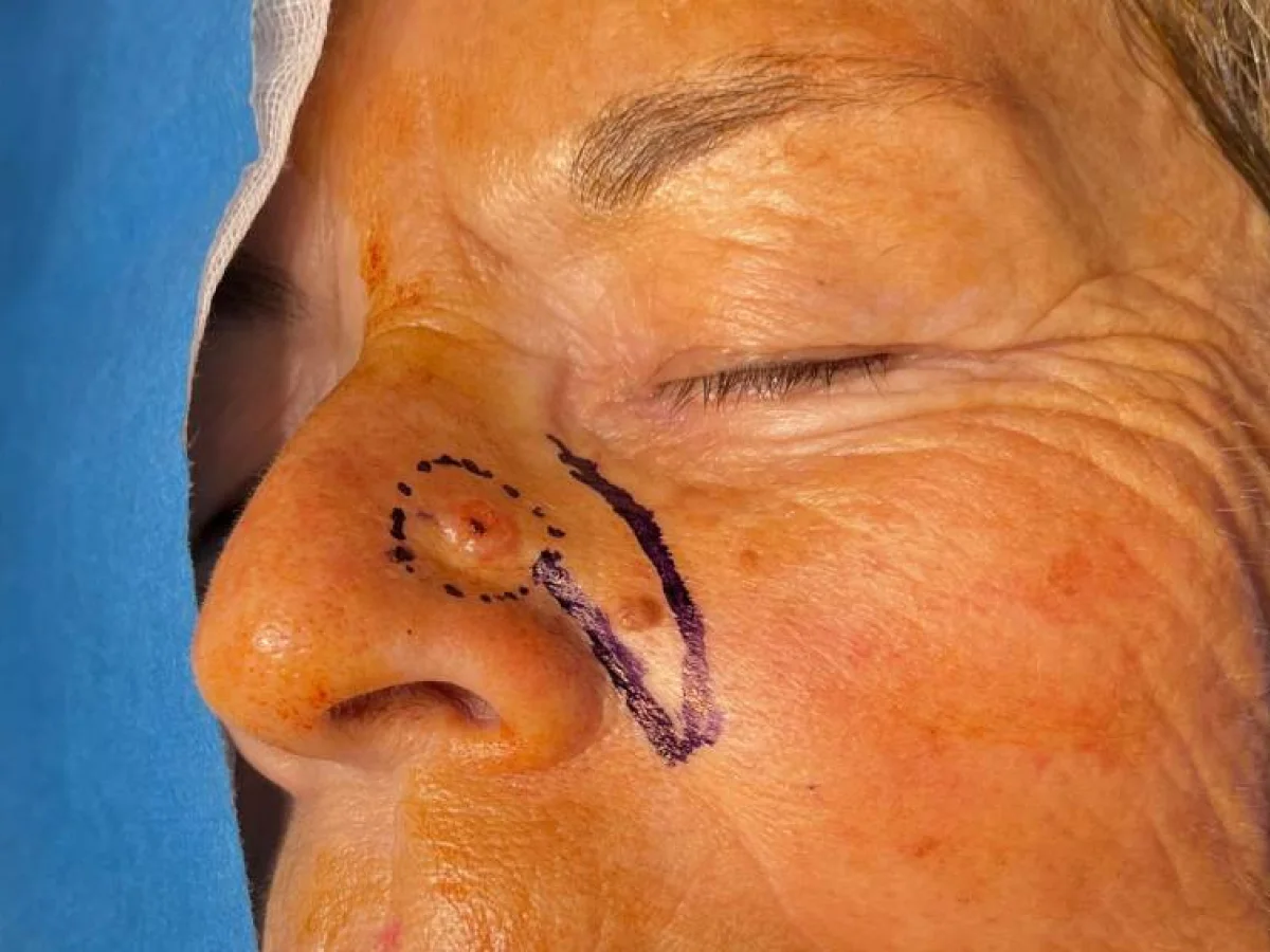 Dr Mikael Nicolai Chirurgien Esthetique Marseille Cest Quoi Un Lambeau En Chirurgie
