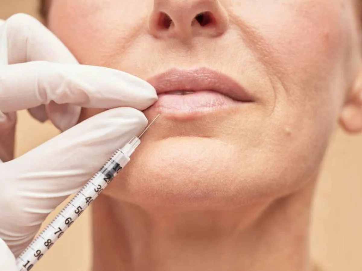 Dr Mikael Nicolai Chirurgien Esthetique Marseille Linjection Dacide Hyaluronique A Marseille