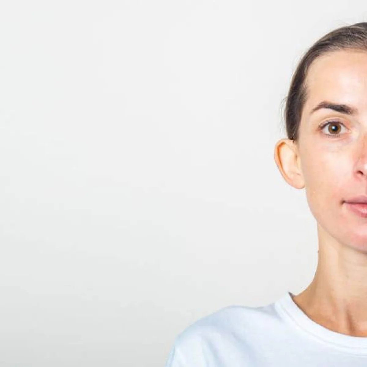 Dr Mikael Nicolai Chirurgien Esthetique Marseille Otoplastie Ou Chirurgie Des Oreilles Decollees