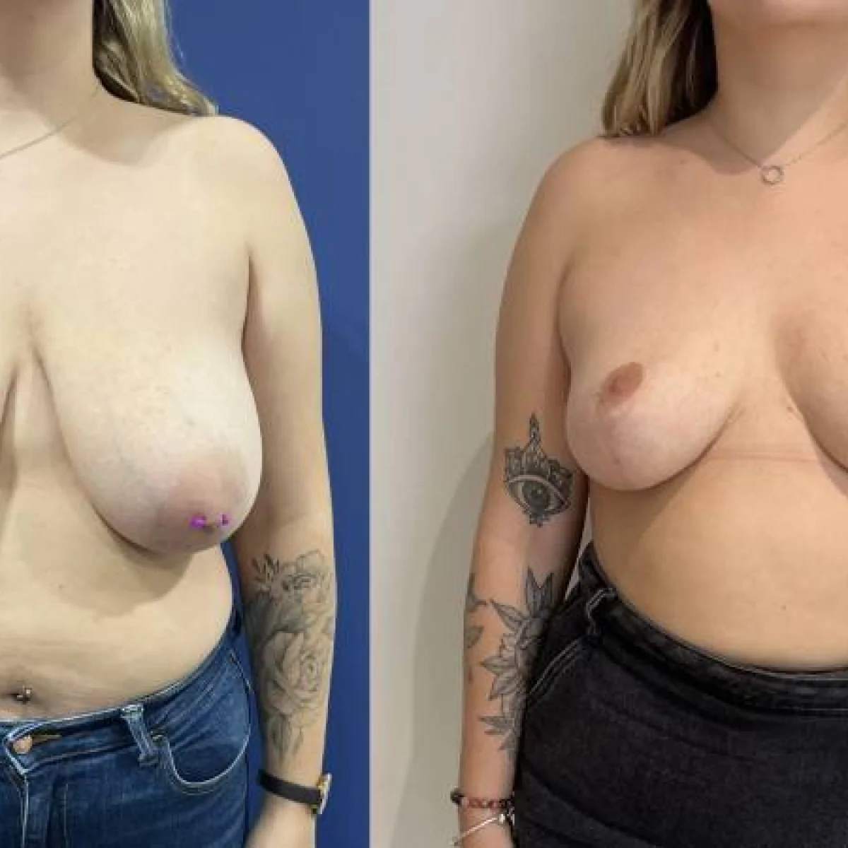Dr Mikael Nicolai Chirurgien Esthetique Marseille Quen Est Il De Lallaitement