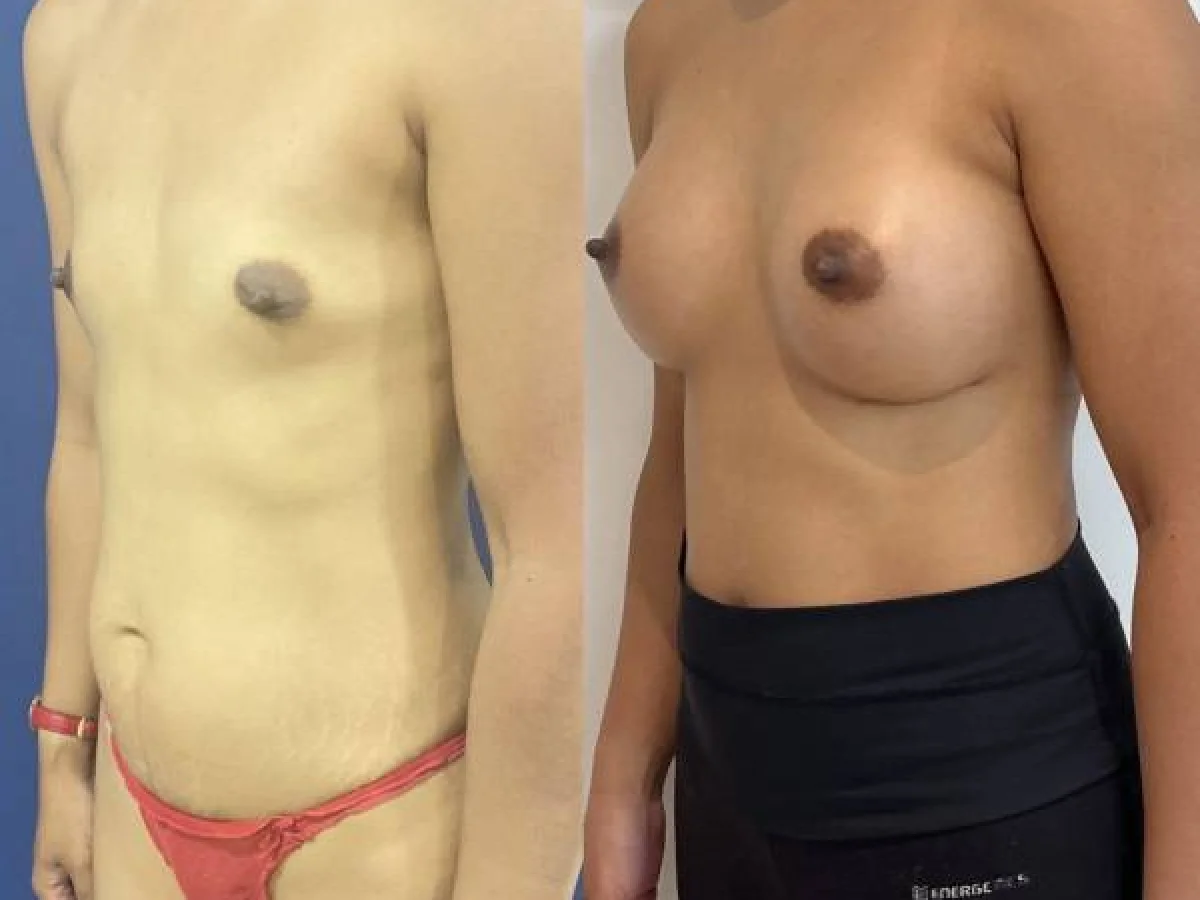Dr Mikael Nicolai Chirurgien Esthetique Marseille Laugmentation Mammaire
