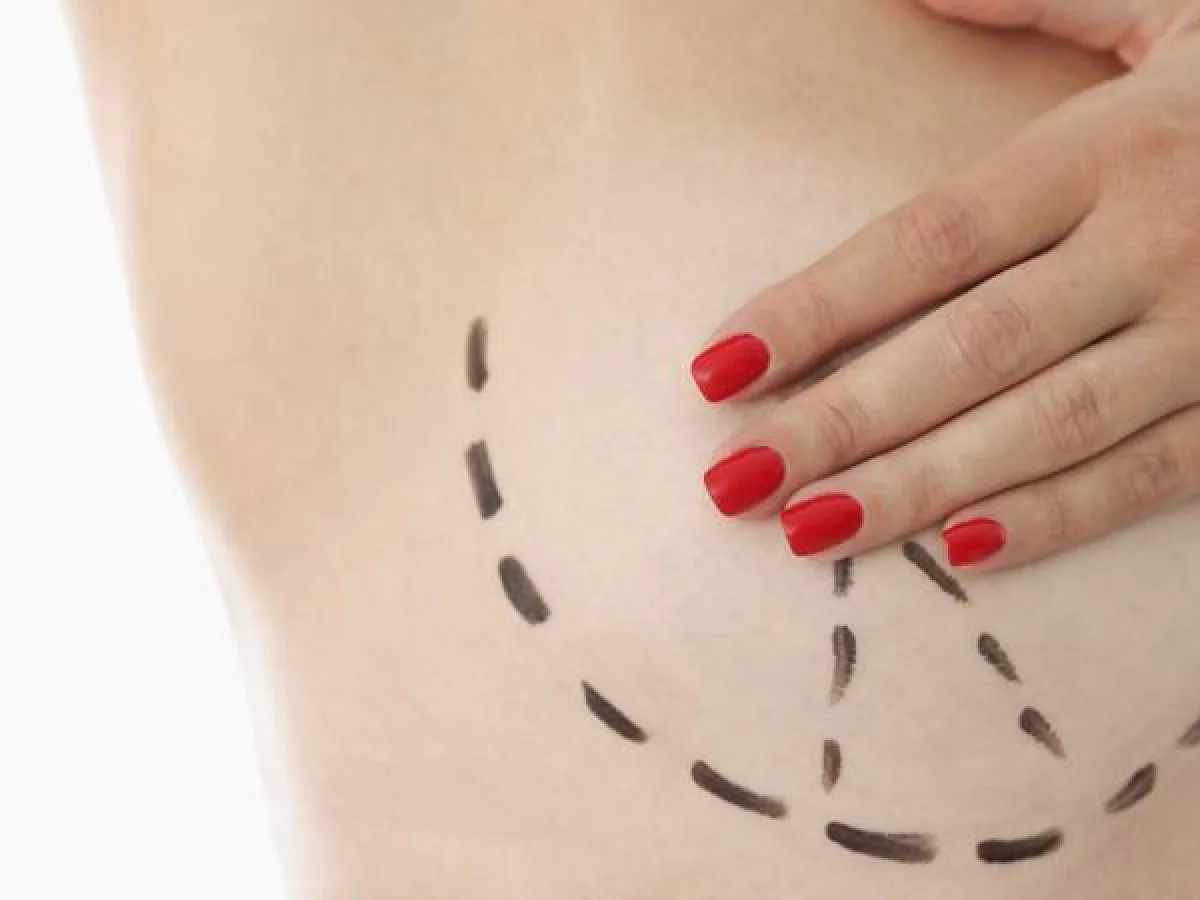 Dr Mikael Nicolai Chirurgien Esthetique Marseille Lifting Mammaire