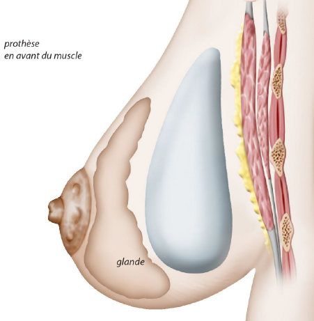 Dr Mikael Nicolai Chirurgien Esthetique Marseille Position Prothese DM