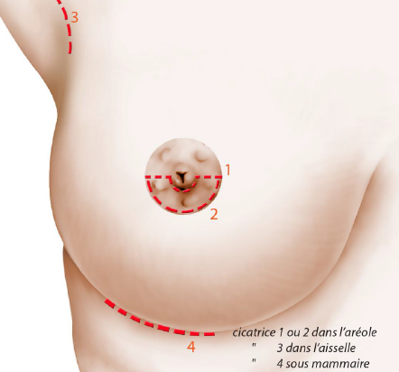 Dr Mikael Nicolai Chirurgien Esthetique Marseille Voies Dabords Seins