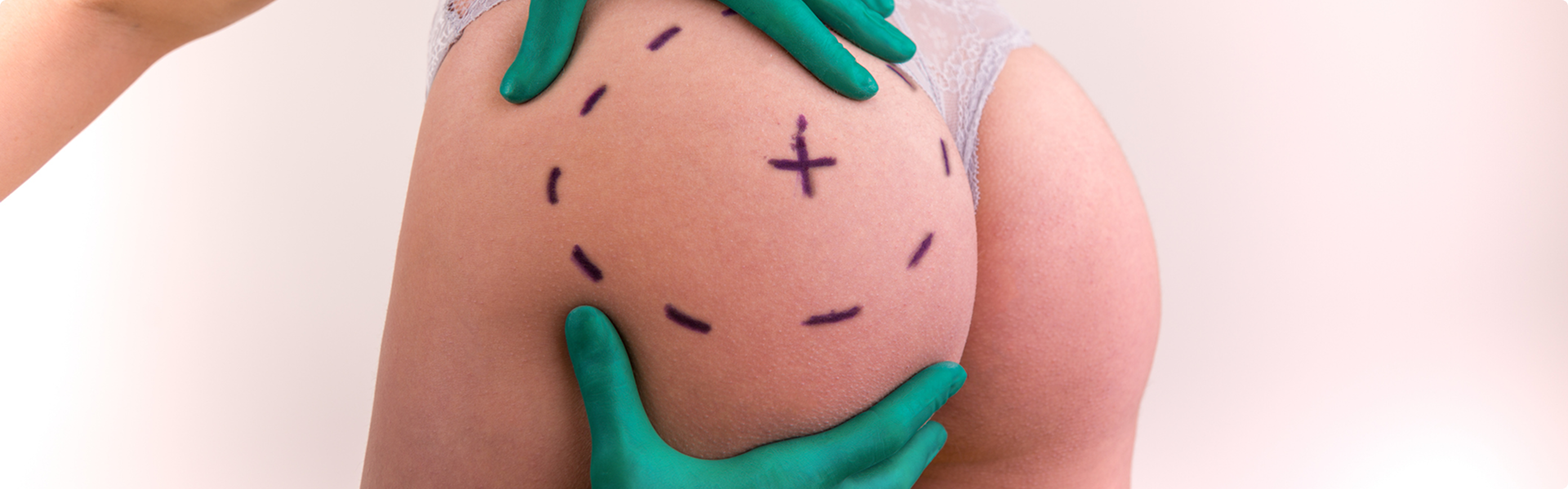 Chirurgie des fesses à Marseille - Dr Mikaël Nicolaï, chirurgie esthétique pour une silhouette galbée