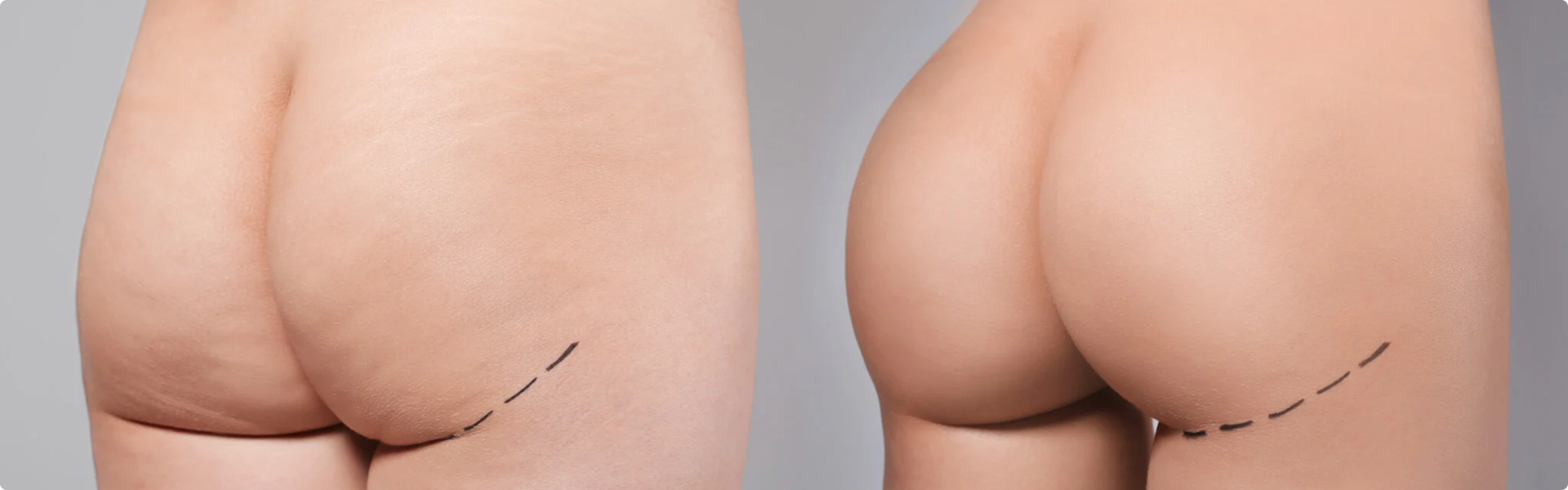 Augmentation des fesses à Aix-en-Provence - Dr Mikaël Nicolaï, expert en augmentation des fesses avec des résultats naturels