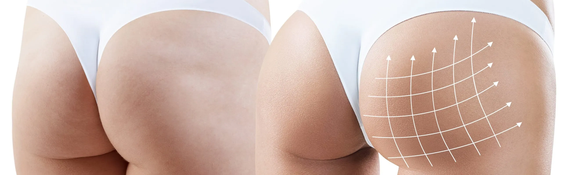 Implants fessiers à Marseille - Dr Mikaël Nicolaï, expert en chirurgie esthétique